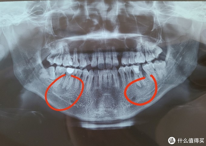 这一拍片子不要紧,发现两颗后槽牙的根尖部分已经出现囊肿,小诊所说