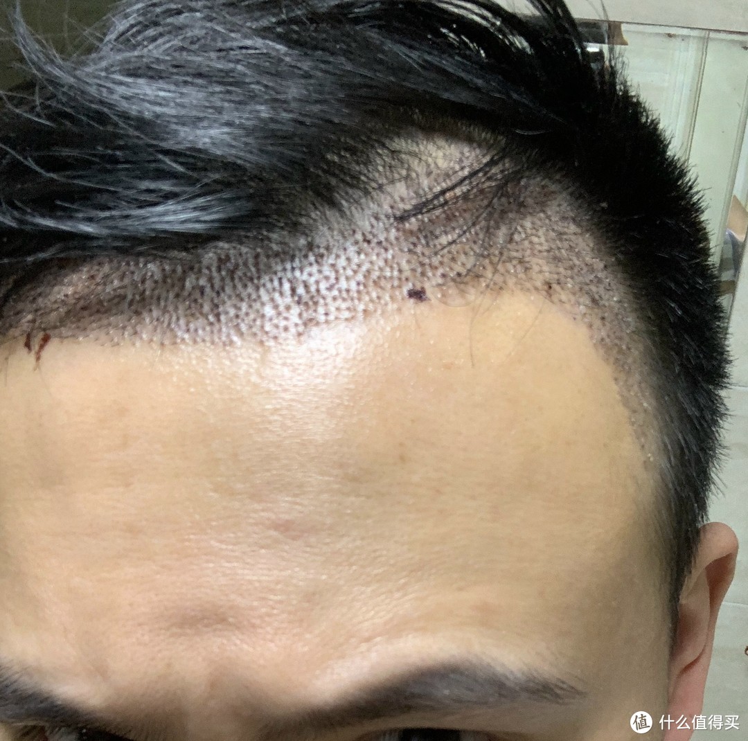 中年男人的倔强m型头的自我拯救植发体验