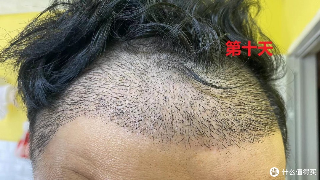 35岁大叔的植发经历植发后第一个月