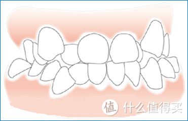 可能是最全的正畸原创文，附正畸用品清单