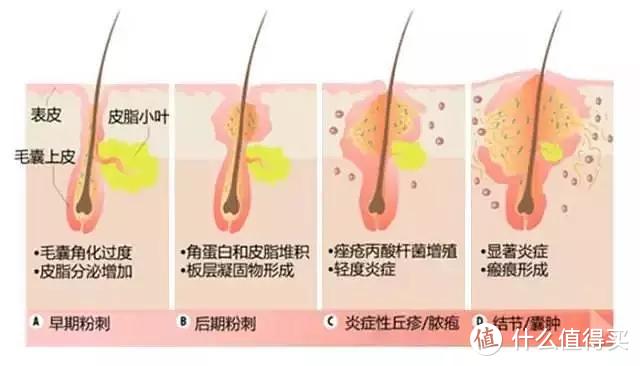 鼻孔两侧毛孔大怎么办？长痘、痘坑怎么办？冻干粉好用吗？