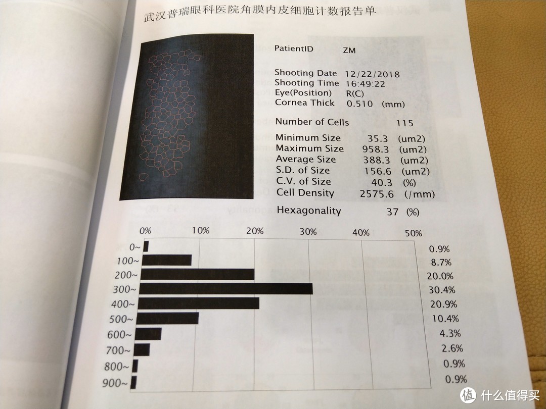 丢掉眼镜的你可以变得更美！——ICL手术检查分享