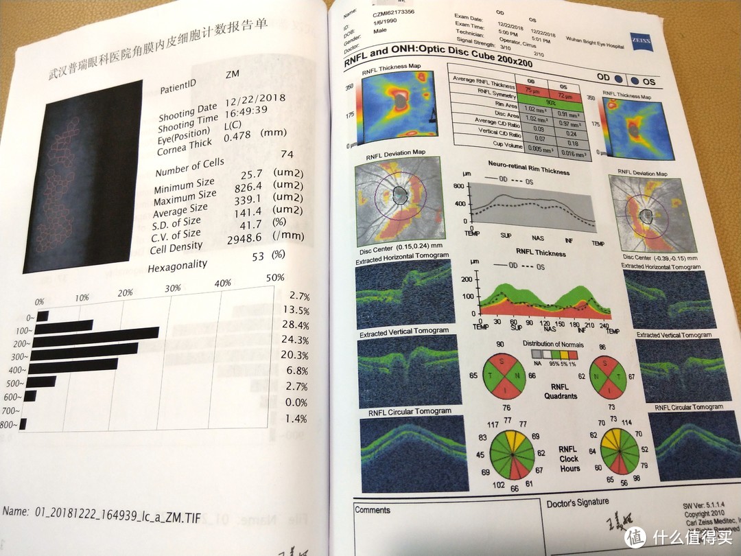 丢掉眼镜的你可以变得更美！——ICL手术检查分享