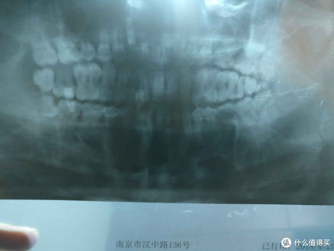 从牙周基础治疗、拔牙到牙周翻瓣手术和种植