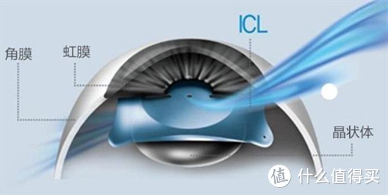 Icl手术篇三 Icl手术过程简述与部分误区问题的解答 眼睛护理 什么值得买