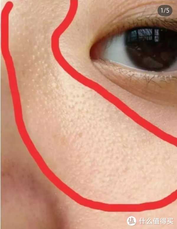皮肤是怎么过敏的？烂脸了靠什么救的？