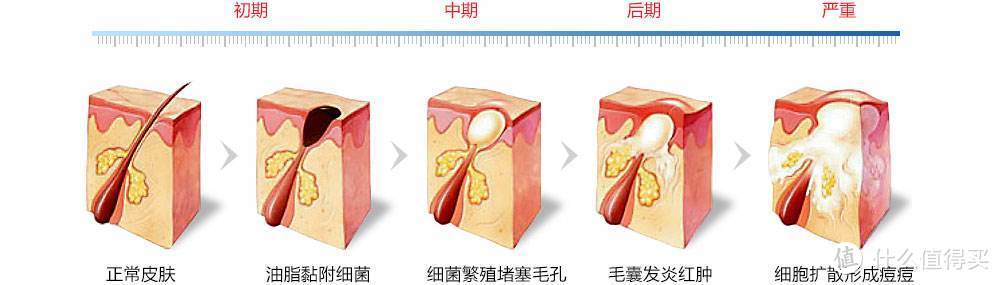 90后老阿姨10年抗痘血泪史：这些坑你入了吗？