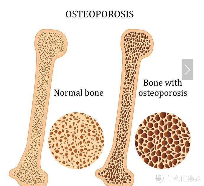 骨质疏松对比