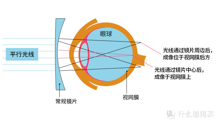 控制青少年近视度数增加该配什么样的镜片