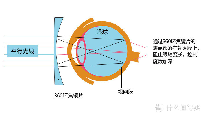 控制青少年近视度数增加该配什么样的镜片