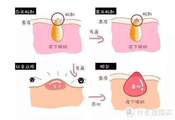 粉刺痤疮大作战，好用不贵的药妆品分享