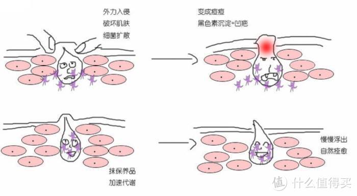 粉刺痤疮大作战，好用不贵的药妆品分享