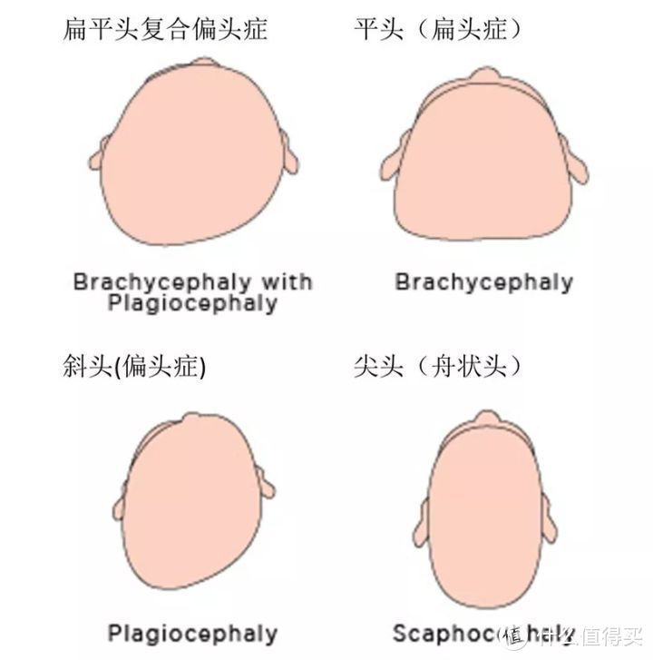 不同类型的偏头、扁头