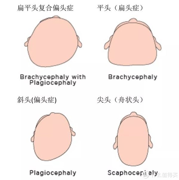 不同类型的偏头、扁头