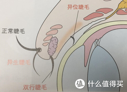 异位睫毛