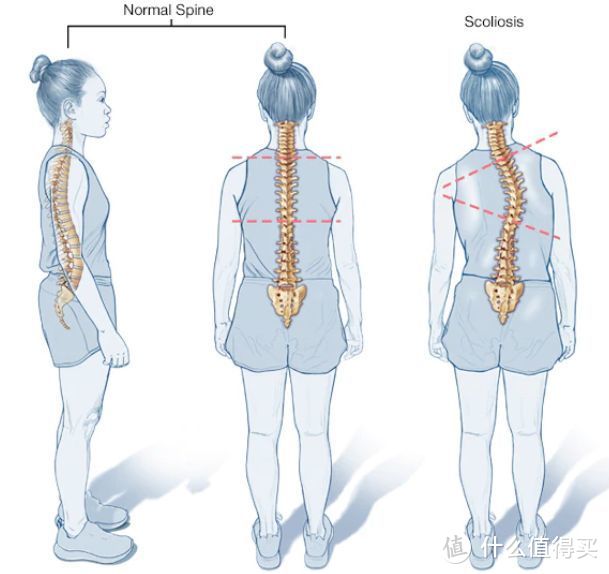 比驼背、骨盆前倾更可怕，脊柱侧弯才是毁体态的第一元凶