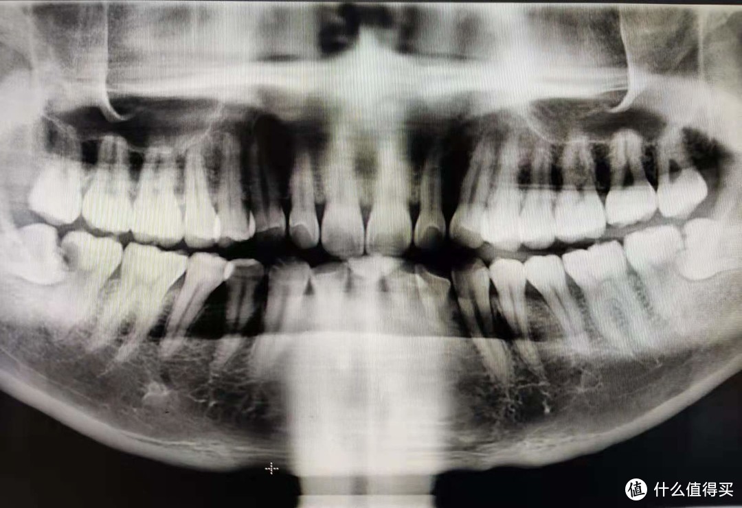 你的智齿需要拔吗？19年末拔牙大记
