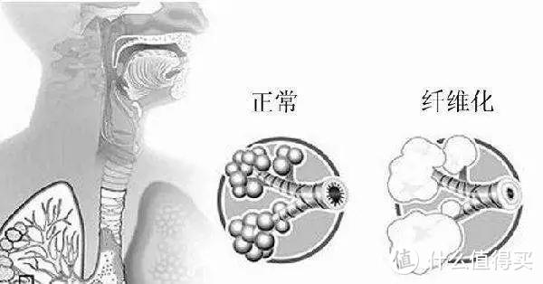 股骨头坏死、慢性胰腺炎…新冠肺炎会造成什么后遗症？