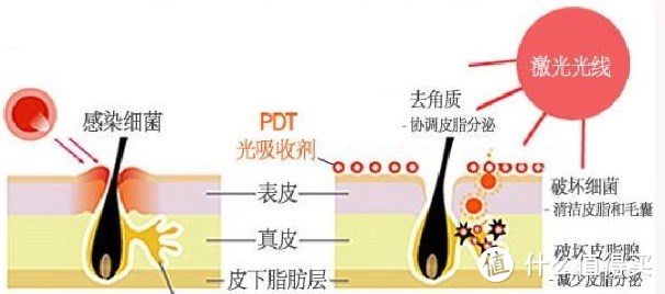 皮肤杀手——粉刺，怎么破？