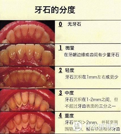 牙结石分度图