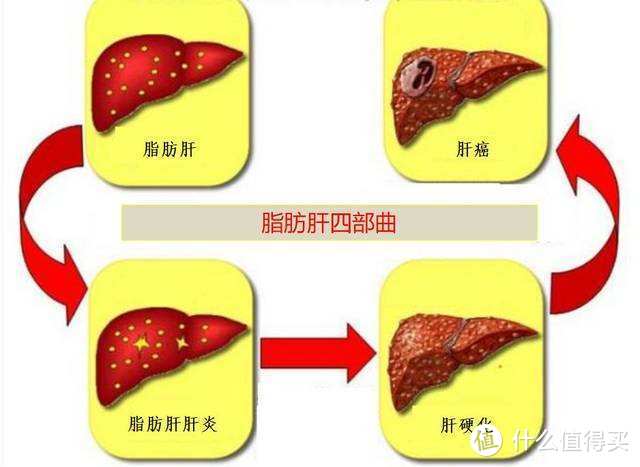 管住嘴迈开腿化解脂肪肝——四千字长文科普脂肪肝