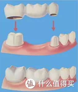 镶牙VS种植牙，你想了解的都在这里！