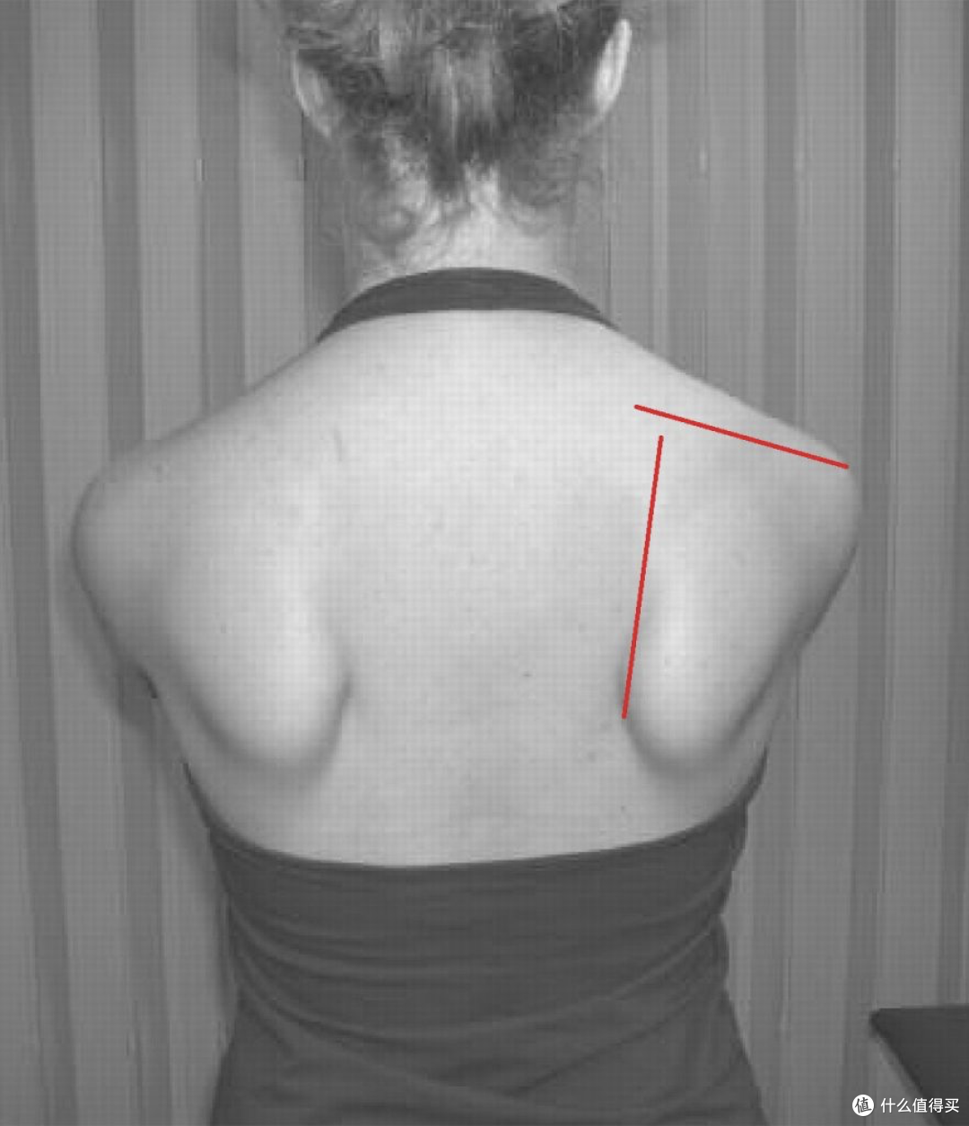 众多女生追求的蝴蝶背身材,其实是一种"病"