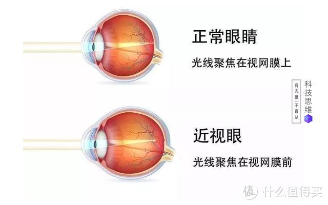 正常眼睛与近视眼睛的对比