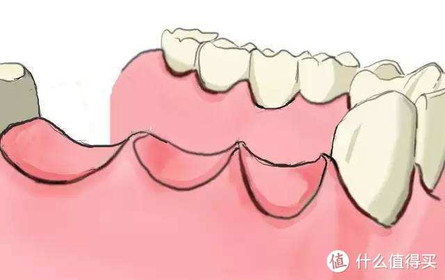 牙齿脱落后怎么办？这几种方法你一定要知道