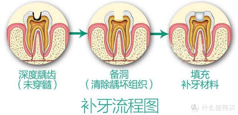 补牙前你需要了解的一些点，也许能让你少遭些罪