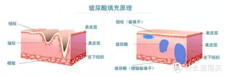 让年龄感倍增的泪沟，我们该拿它怎么办？