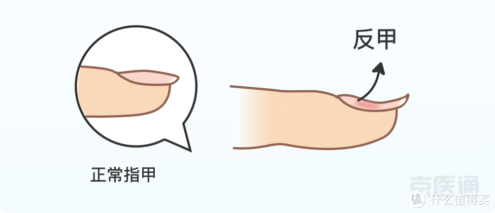 指甲上没月牙、有横线、长倒刺，是身体出问题了吗？