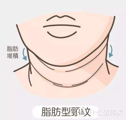 有的人群会因为后天导致的肥胖,而造成颈部脂肪堆积,颈部皮肤本来就薄