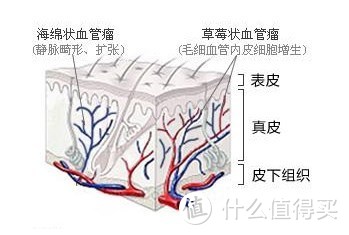 关于胎记的那些事，你知道吗？