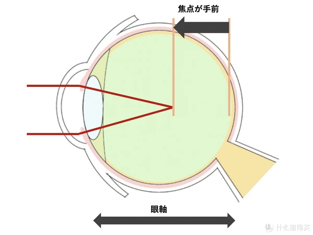 治疗近视眼镜在美进行临床试验，号称可缩短“眼轴”