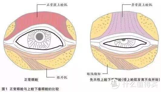 你还分不清上睑下垂与上睑松弛吗？看完你就明白了！