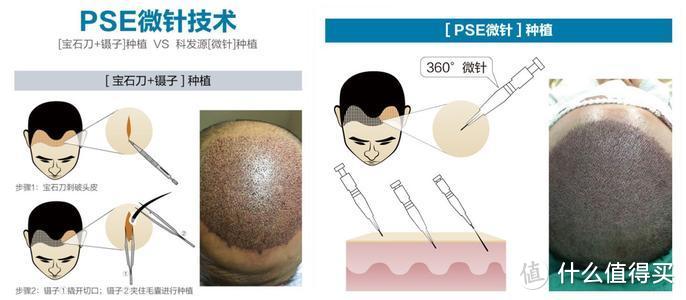 我还有机会么？各类植发技术分析，揭开守护发际线的真相！