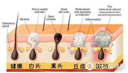 太全了！为什么反复长痘？深度痤疮科普及针对性产品推荐