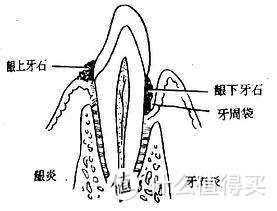 左侧是牙龈炎牙石在牙龈上方.