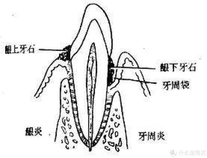 龈下刮治真不疼亲历经验牙周病克星不可怕很温柔
