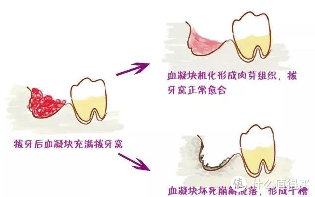 拔完智齿还不算完，护理不好得了干槽症才让人头疼