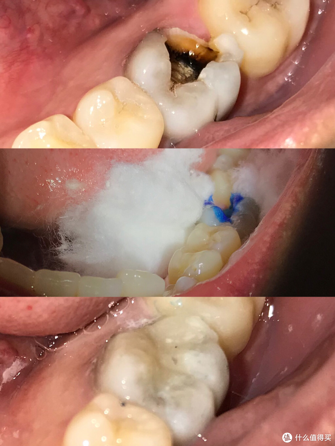 述说十年来在牙齿上的坎坷经历 拔智齿 拔多生齿 根管治疗 牙冠 洗牙 我知道的全都告诉你 口腔健康 什么值得买