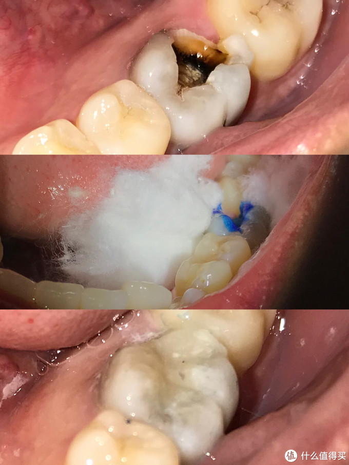 述說十年來在牙齒上的坎坷經歷拔智齒拔多生齒根管治療牙冠洗牙我知道