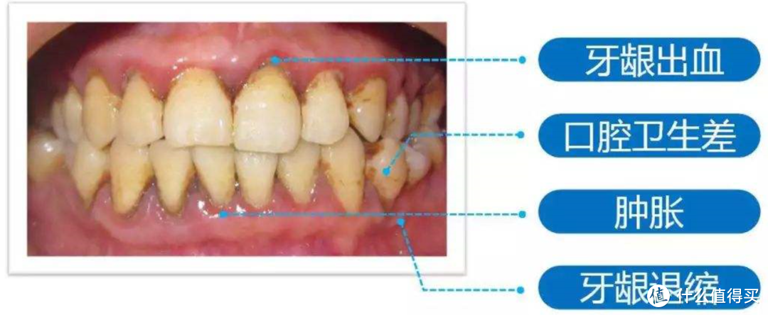 牙周病的典型图示