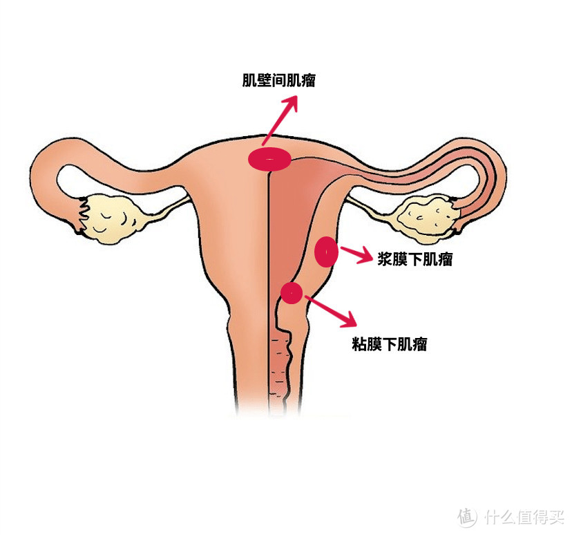 簡單來說就是子宮長了一個或者多個肉疙瘩.