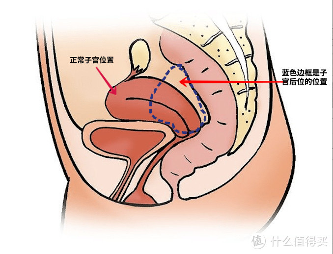 健康日历 篇十九：「子宫后位」需要进行治疗吗？