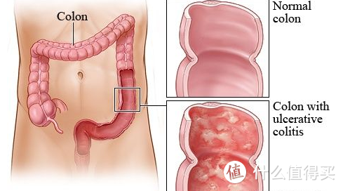 “新”重疾详解（3）：严重溃疡性结肠炎