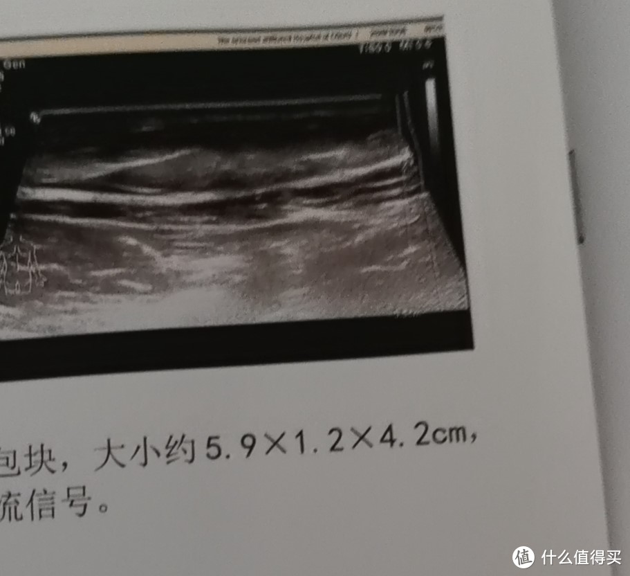 由几千变成几百 脂肪瘤切除体验 运动健康 什么值得买