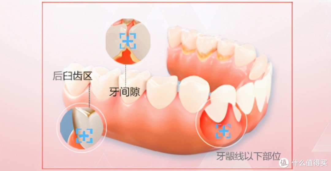 为什么我用上了电动牙刷，还是长了蛀牙