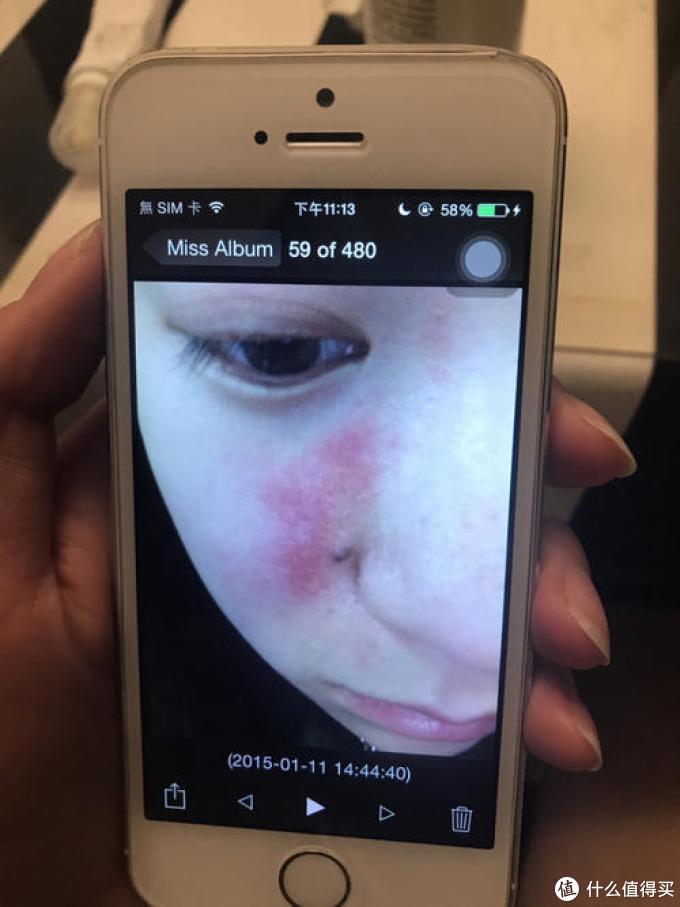 脂溢性皮炎自救之路可抑不好治